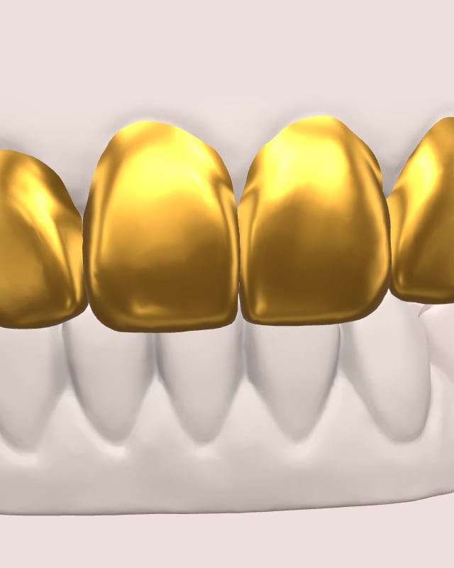 Six upper teeth in 20K yellow gold on the 3D jaw, in Blush